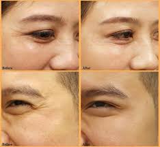 Xóa nhăn bằng Botox