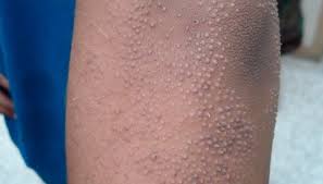 Điều trị viêm - dày sừng nang lông