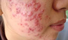 Điều trị mụn viêm, mụn bọc